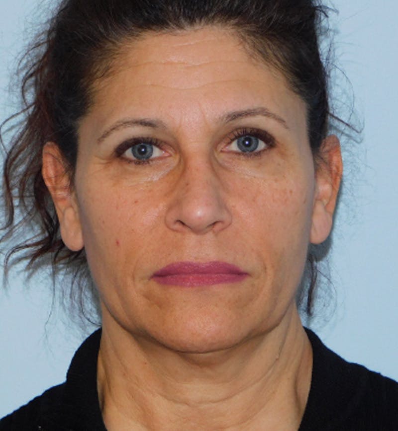 Mini-Facelift Before & After Gallery - Patient 152862339 - Image 1