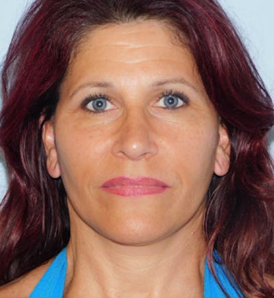 Mini-Facelift Before & After Gallery - Patient 152862339 - Image 2