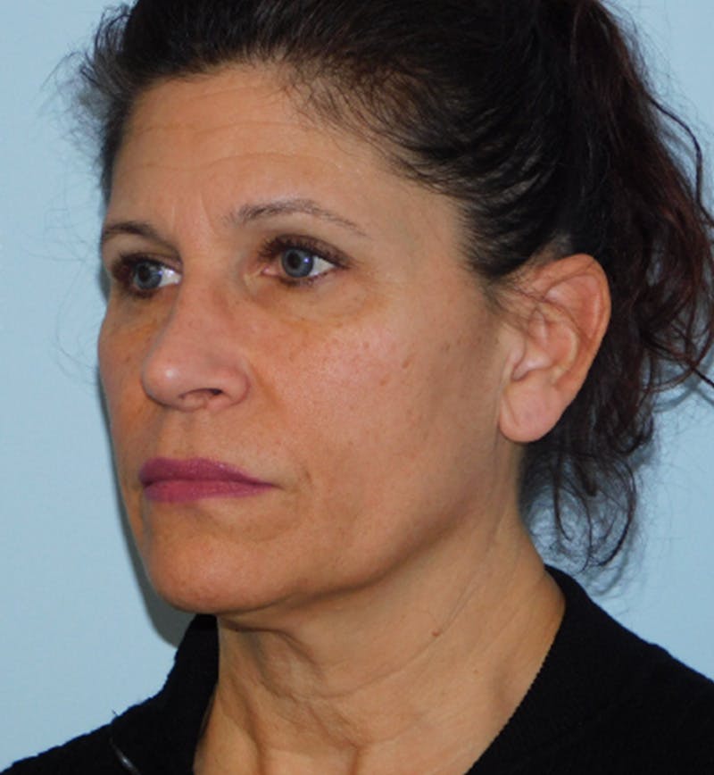 Mini-Facelift Before & After Gallery - Patient 152862339 - Image 3