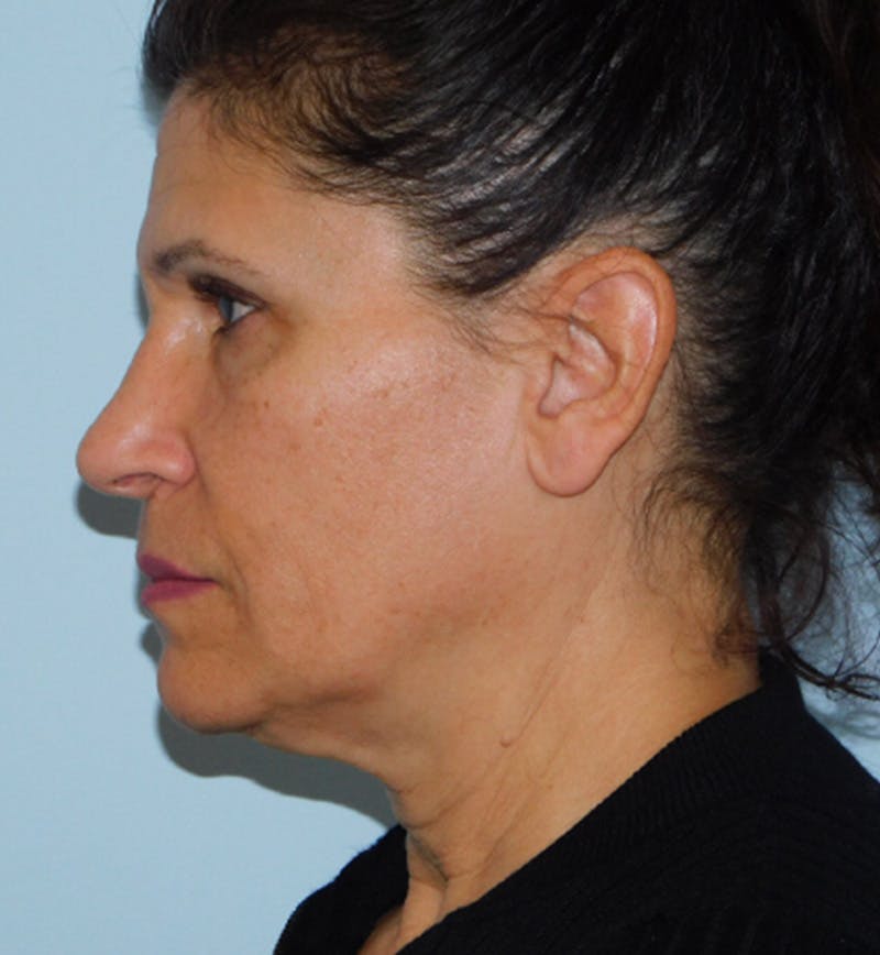 Mini-Facelift Before & After Gallery - Patient 152862339 - Image 5