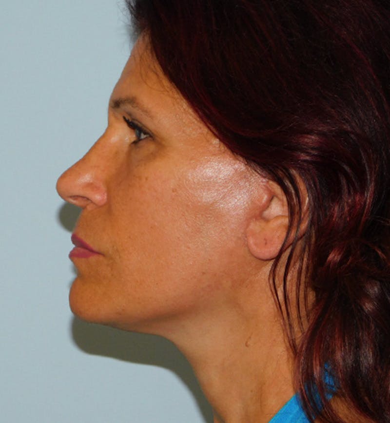 Mini-Facelift Before & After Gallery - Patient 152862339 - Image 6