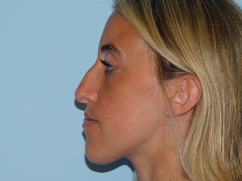 Rhinoplasty Before & After Gallery - Patient 152862964 - Image 1