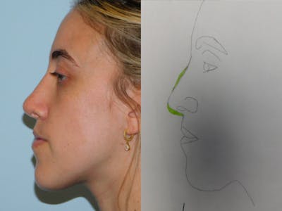 Rhinoplasty Before & After Gallery - Patient 152862964 - Image 2