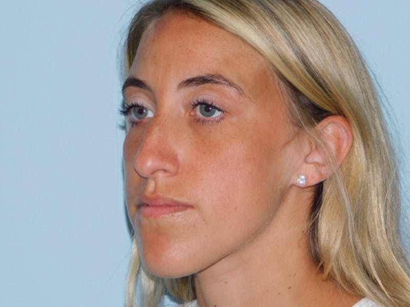 Rhinoplasty Before & After Gallery - Patient 152862964 - Image 3