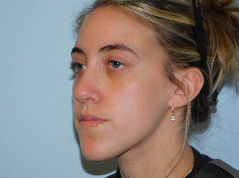 Rhinoplasty Before & After Gallery - Patient 152862964 - Image 4