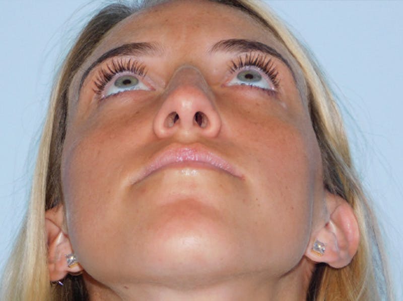 Rhinoplasty Before & After Gallery - Patient 152862964 - Image 5