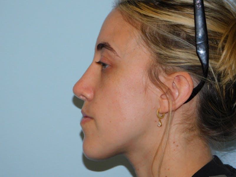 Rhinoplasty Before & After Gallery - Patient 152862964 - Image 8