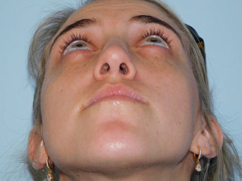 Rhinoplasty Before & After Gallery - Patient 152862964 - Image 6