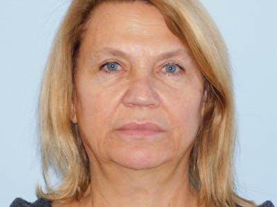 Facelift Before & After Gallery - Patient 155429904 - Image 1