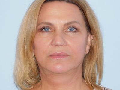 Facelift Before & After Gallery - Patient 155429904 - Image 2