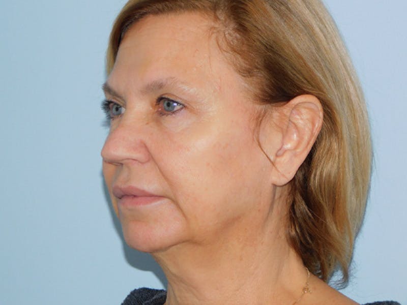 Facelift Before & After Gallery - Patient 155429904 - Image 3