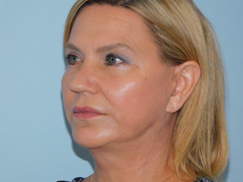 Facelift Before & After Gallery - Patient 155429904 - Image 4