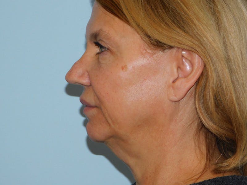 Facelift Before & After Gallery - Patient 155429904 - Image 5