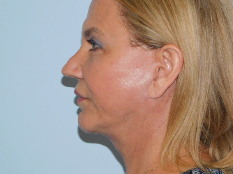 Facelift Before & After Gallery - Patient 155429904 - Image 6