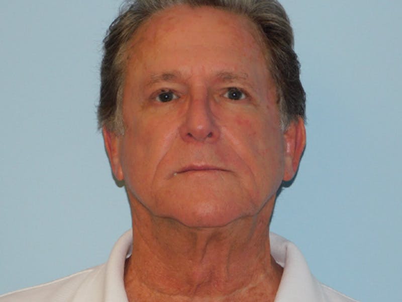 Facelift Before & After Gallery - Patient 155429905 - Image 5