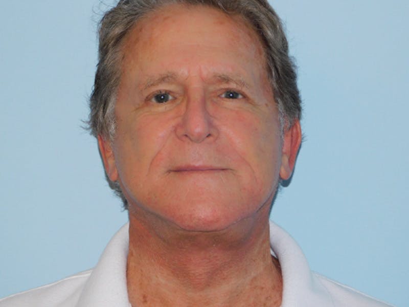 Facelift Before & After Gallery - Patient 155429905 - Image 6