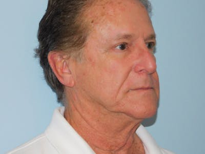 Facelift Before & After Gallery - Patient 155429905 - Image 1