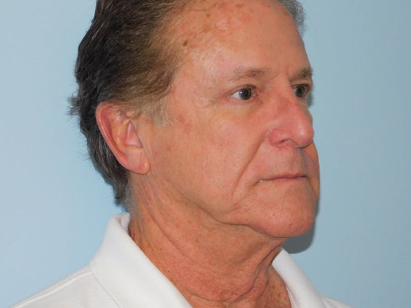 Facelift Before & After Gallery - Patient 155429905 - Image 1