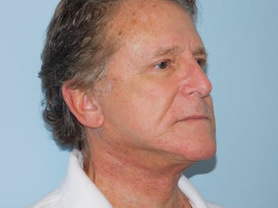 Facelift Before & After Gallery - Patient 155429905 - Image 2