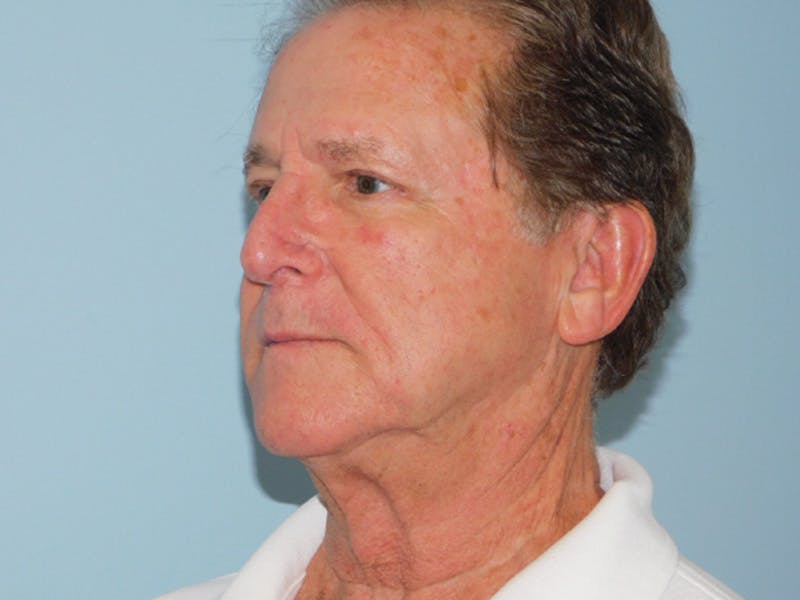 Facelift Before & After Gallery - Patient 155429905 - Image 3