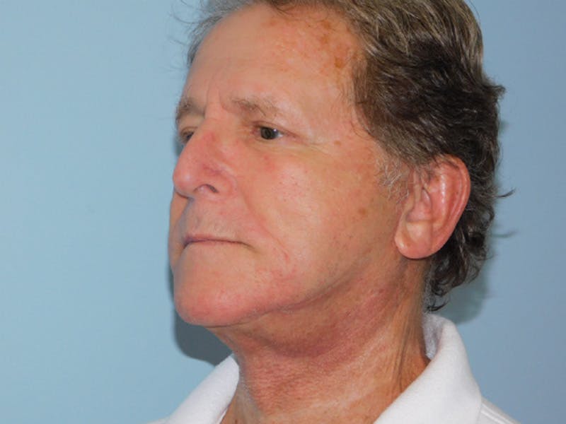 Facelift Before & After Gallery - Patient 155429905 - Image 4