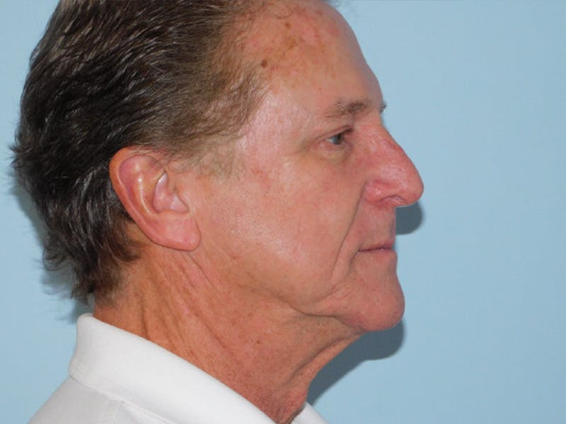 Facelift Before & After Gallery - Patient 155429905 - Image 7