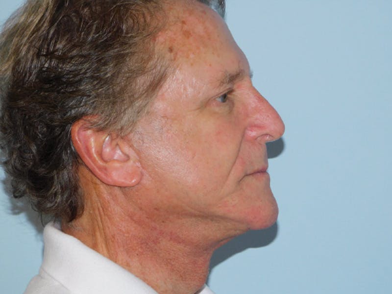 Facelift Before & After Gallery - Patient 155429905 - Image 8