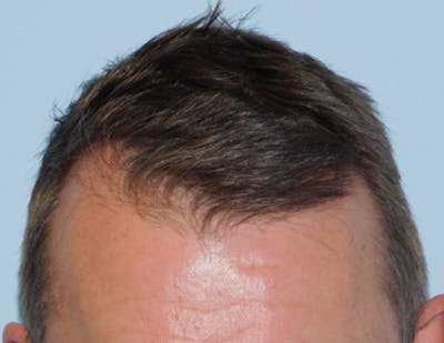 Hair Transplant (Smartgraft) Before & After Gallery - Patient 156819787 - Image 1