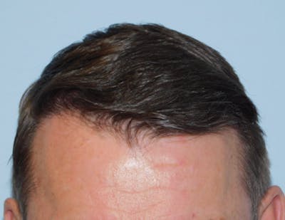 Hair Transplant (Smartgraft) Before & After Gallery - Patient 156819787 - Image 2