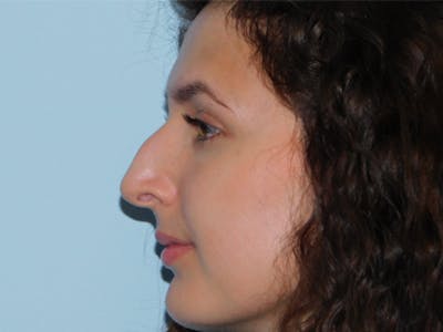 Rhinoplasty Before & After Gallery - Patient 156819796 - Image 1