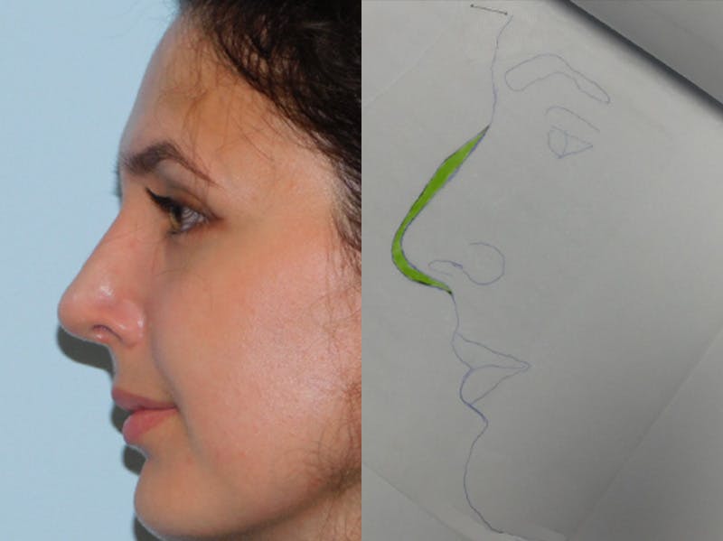 Rhinoplasty Before & After Gallery - Patient 156819796 - Image 2