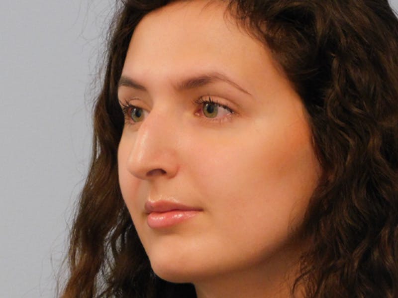 Rhinoplasty Before & After Gallery - Patient 156819796 - Image 3