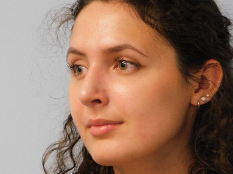 Rhinoplasty Before & After Gallery - Patient 156819796 - Image 4