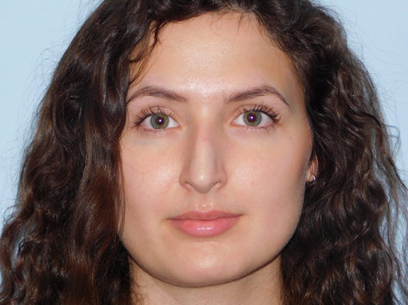 Rhinoplasty Before & After Gallery - Patient 156819796 - Image 5