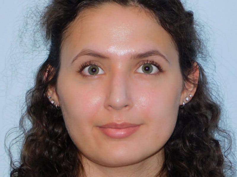 Rhinoplasty Before & After Gallery - Patient 156819796 - Image 6