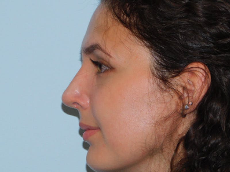 Rhinoplasty Before & After Gallery - Patient 156819796 - Image 8