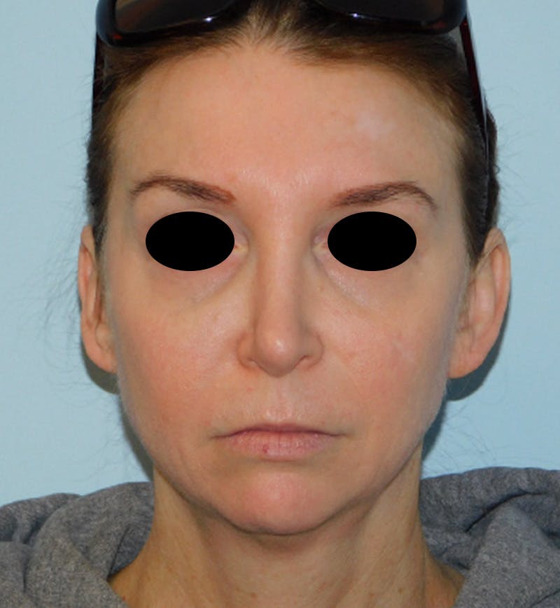 Mini-Facelift Before & After Gallery - Patient 156819823 - Image 3