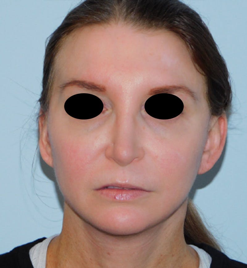 Mini-Facelift Before & After Gallery - Patient 156819823 - Image 4
