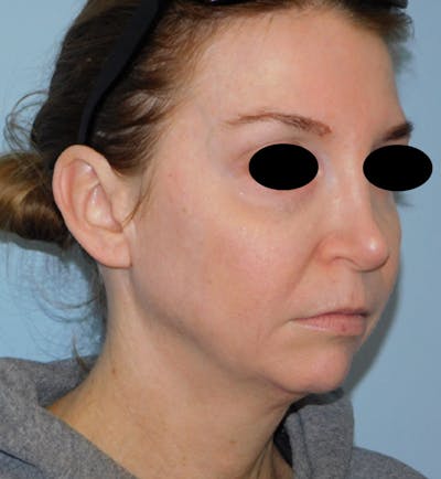 Mini-Facelift Before & After Gallery - Patient 156819823 - Image 1