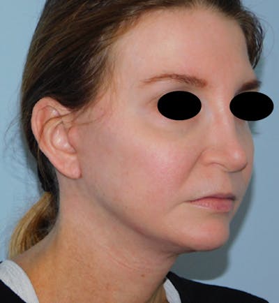 Mini-Facelift Before & After Gallery - Patient 156819823 - Image 2