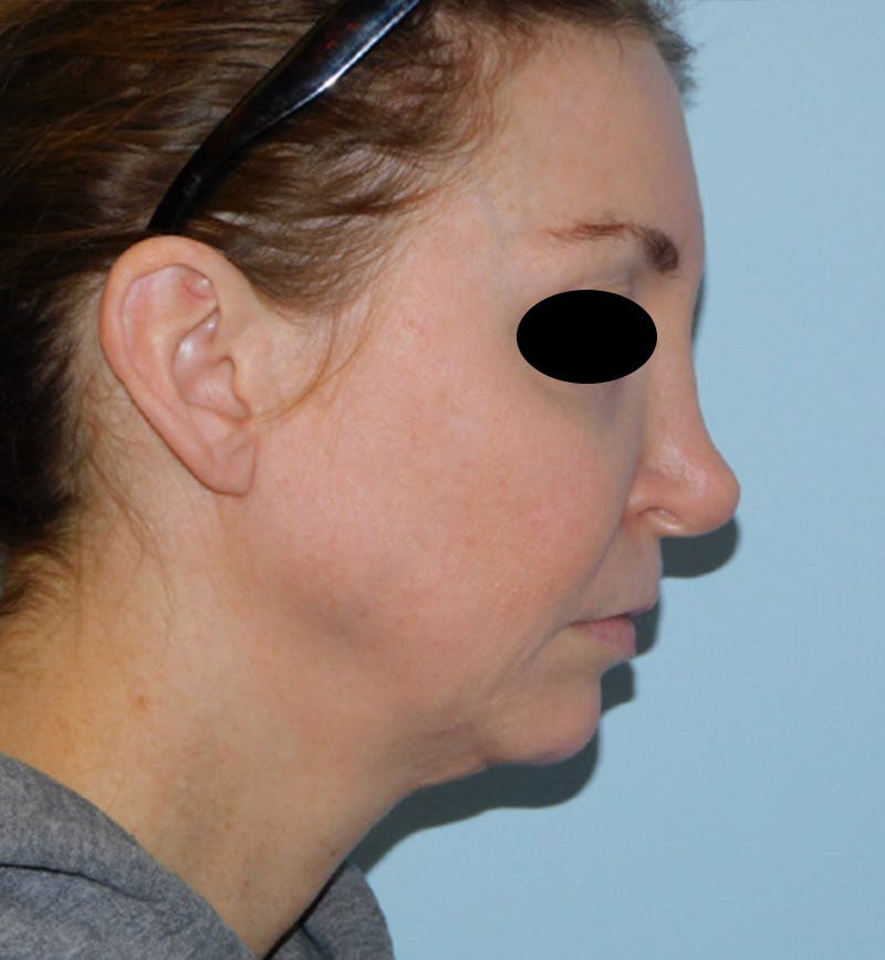 Mini-Facelift Before & After Gallery - Patient 156819823 - Image 5