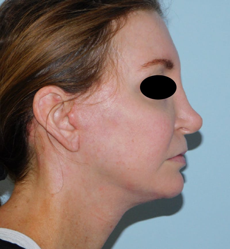 Mini-Facelift Before & After Gallery - Patient 156819823 - Image 6