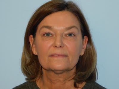 Facelift Before & After Gallery - Patient 158120799 - Image 1