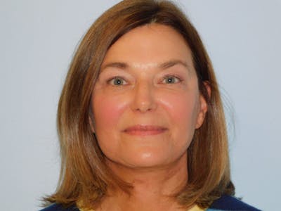Facelift Before & After Gallery - Patient 158120799 - Image 2