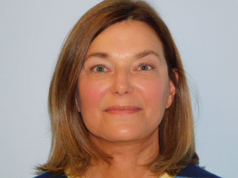 Facelift Before & After Gallery - Patient 158120799 - Image 2