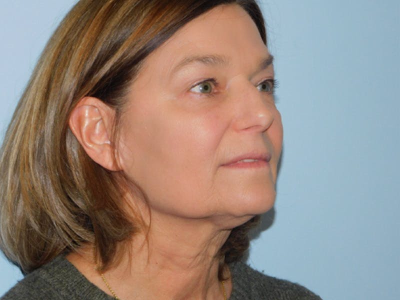 Facelift Before & After Gallery - Patient 158120799 - Image 3