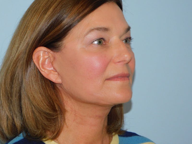 Facelift Before & After Gallery - Patient 158120799 - Image 4