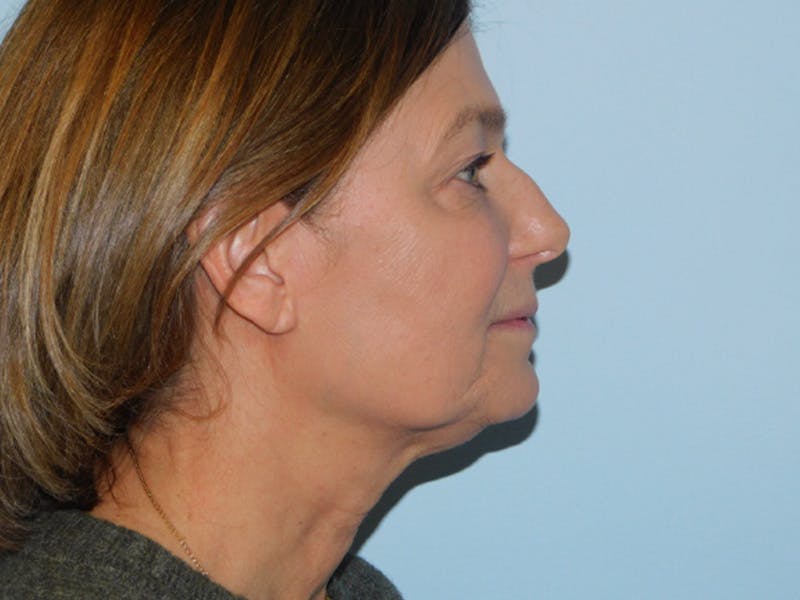 Facelift Before & After Gallery - Patient 158120799 - Image 5