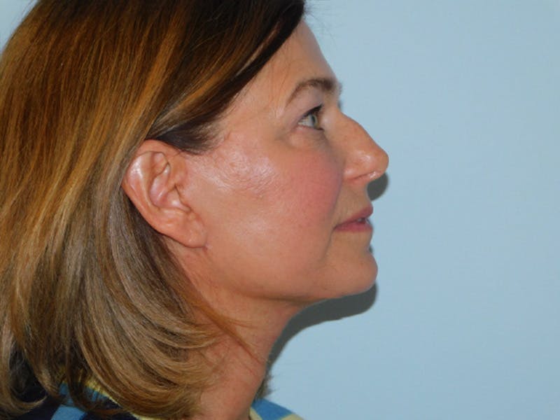Facelift Before & After Gallery - Patient 158120799 - Image 6