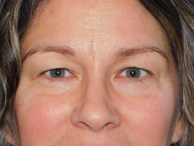 Blepharoplasty (Eyelid Lift) Before & After Gallery - Patient 160783531 - Image 1